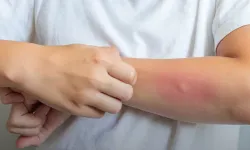 Egzama yalnızca cildi değil, sosyal yaşamı da etkileyebiliyor